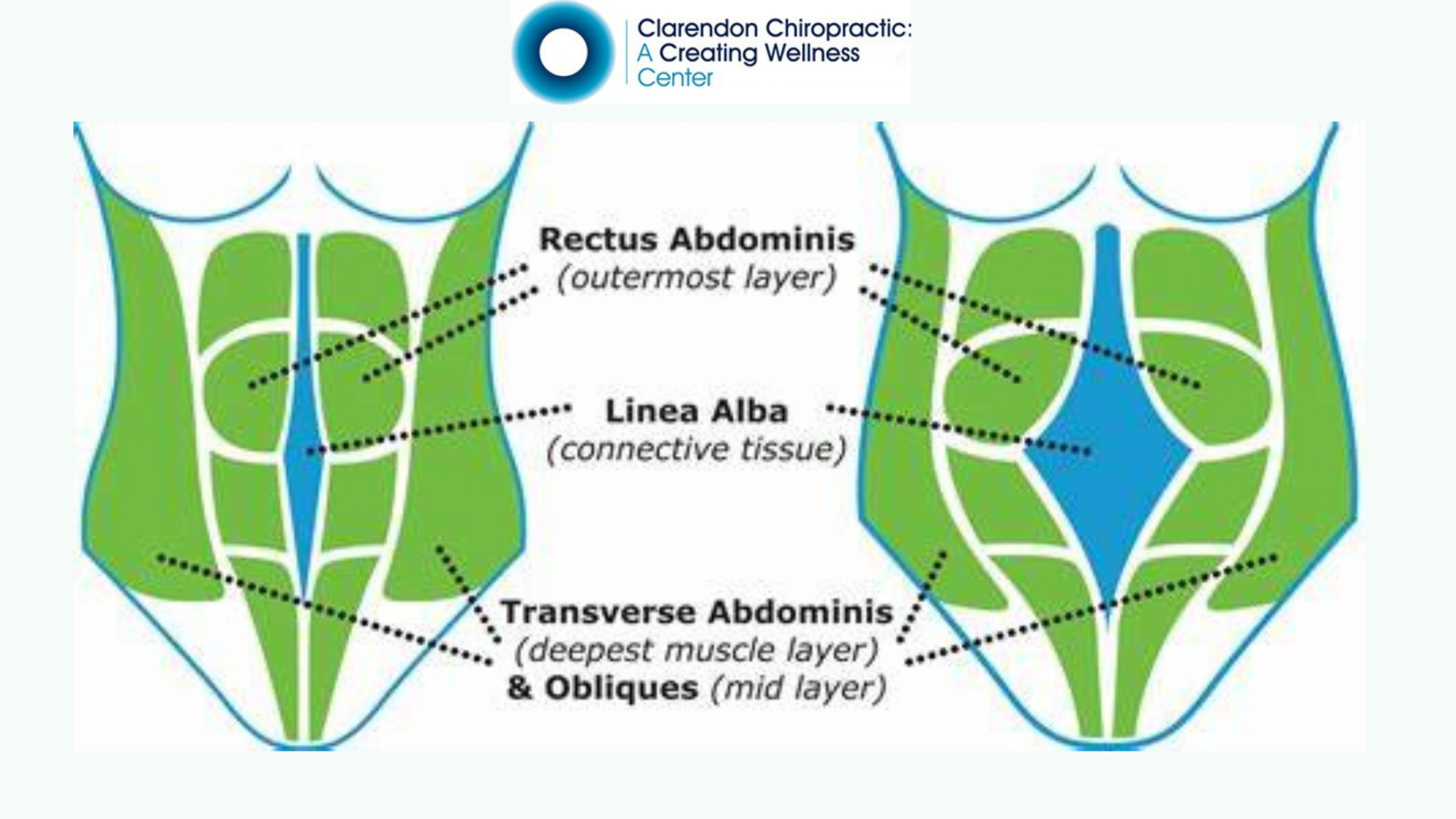 Symptoms & Treatment of Diastasis Recti or Abdominal Separation