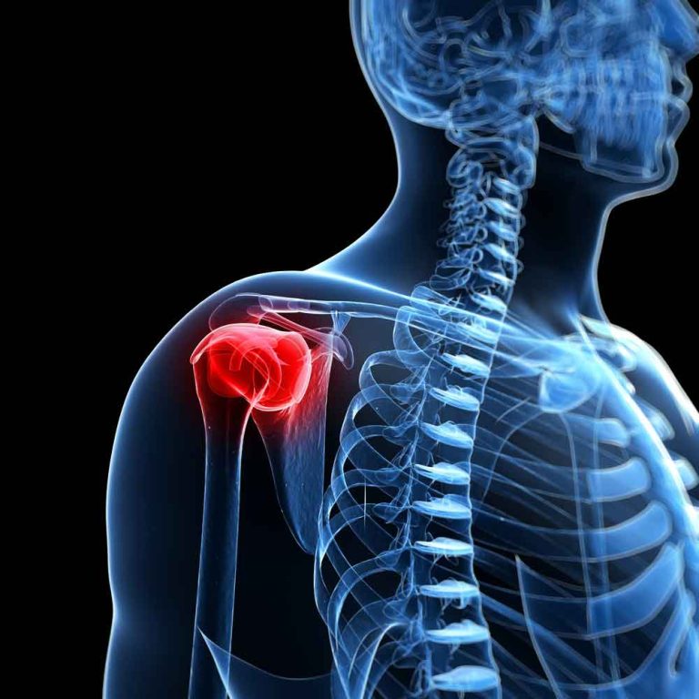 What is causing the pain between my shoulder blades & how can I treat it? Clarendon Chiropractic